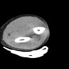 SPORK, NICO - 22.03.1976 - 02.08.2022 - CT obere Extremität - 17:56:57